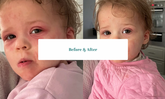 Treating Eczema in the Balanced Beings Clinic
